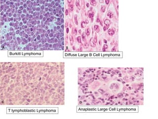 Burkitt Lymphoma Diffuse Large B Cell Lymphoma
T lymphoblastic Lymphoma Anaplastic Large Cell Lymphoma
 