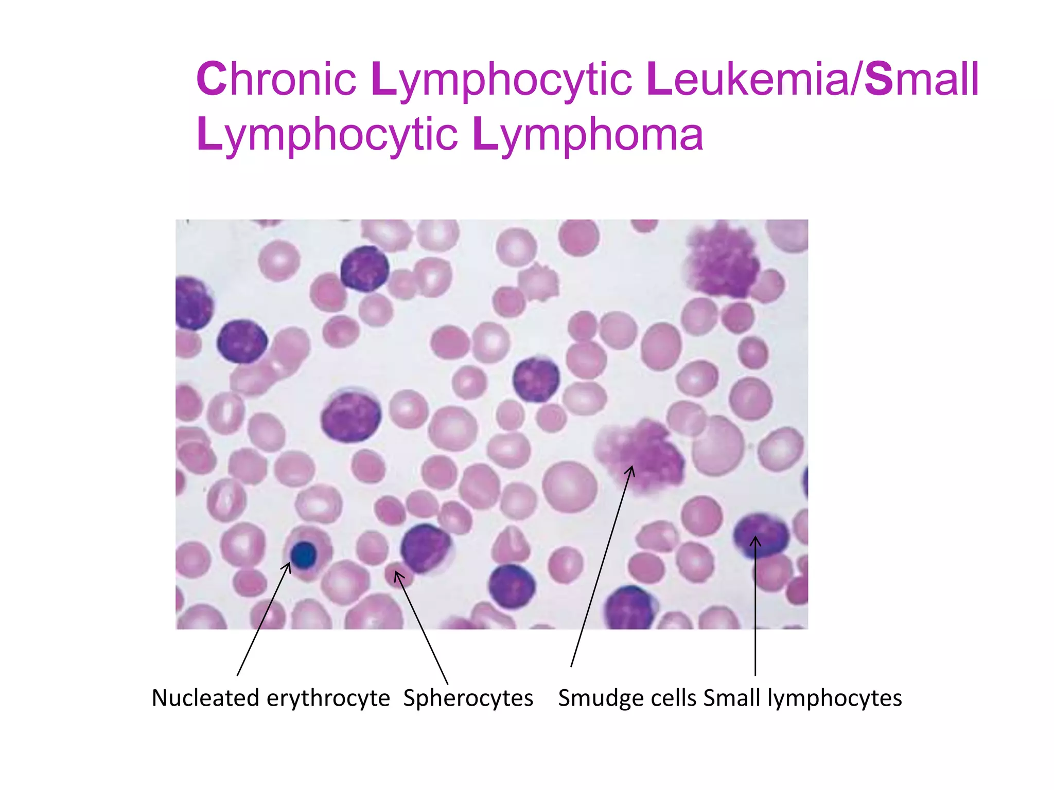 Lymphoma lecture(1) | PPTX