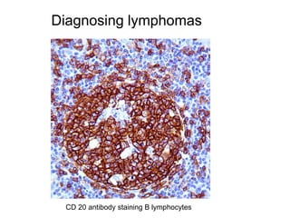 Lymphoma lecture(1) | PPTX