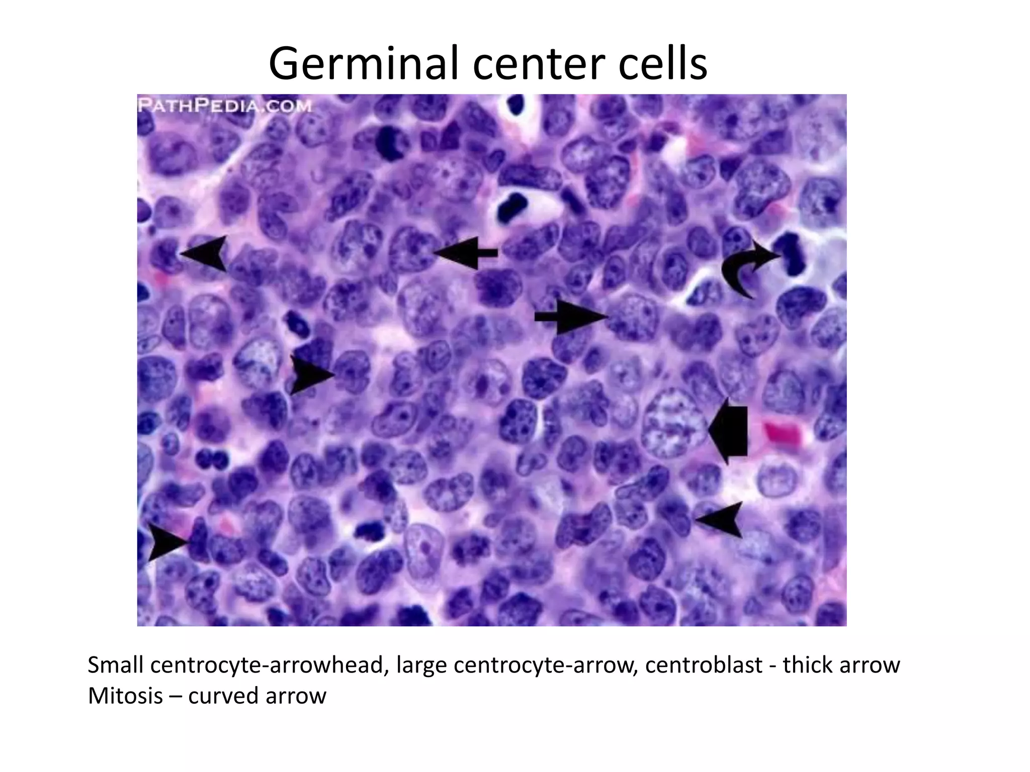 Lymphoma lecture(1) | PPTX