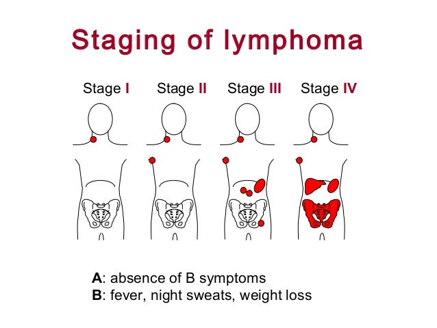 What is stage IV lymphoma?