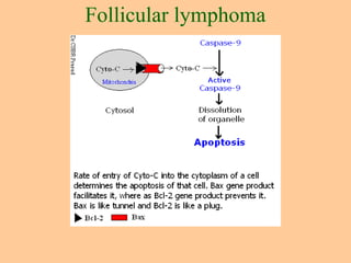 Follicular lymphoma
 
