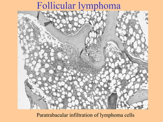 Paratrabacular infiltration of lymphoma cells
Follicular lymphoma
 