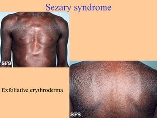 Sezary syndrome
Exfoliative erythroderma
 