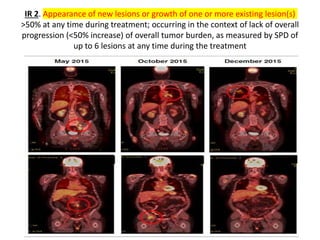 Lymphoma staging and response evolution with current recommendations (2 ...