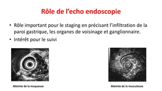 Rôle de l’echo endoscopie
• Rôle important pour le staging en précisant l’infiltration de la
paroi gastrique, les organes de voisinage et ganglionnaire.
• Intérêt pour le suivi
Atteinte de la muqueuse Atteinte de la musculeuse
 