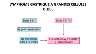 LYMPHOME GASTRIQUE A GRANDES CELLULES
DLBCL
 