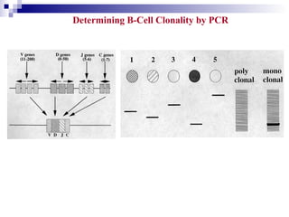 Determining B-Cell Clonality by PCR
 