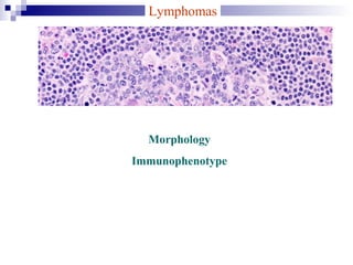 Lymphomas
Morphology
Immunophenotype
 