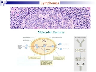 Lymphomas
Molecular Features
 
