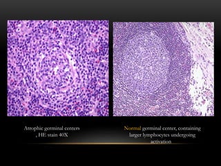 Atrophic germinal centers
, HE stain 40X
Normal germinal center, containing
larger lymphocytes undergoing
activation
 