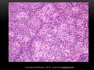Vascular proliferation ,20 X, increased angiogenesis
 