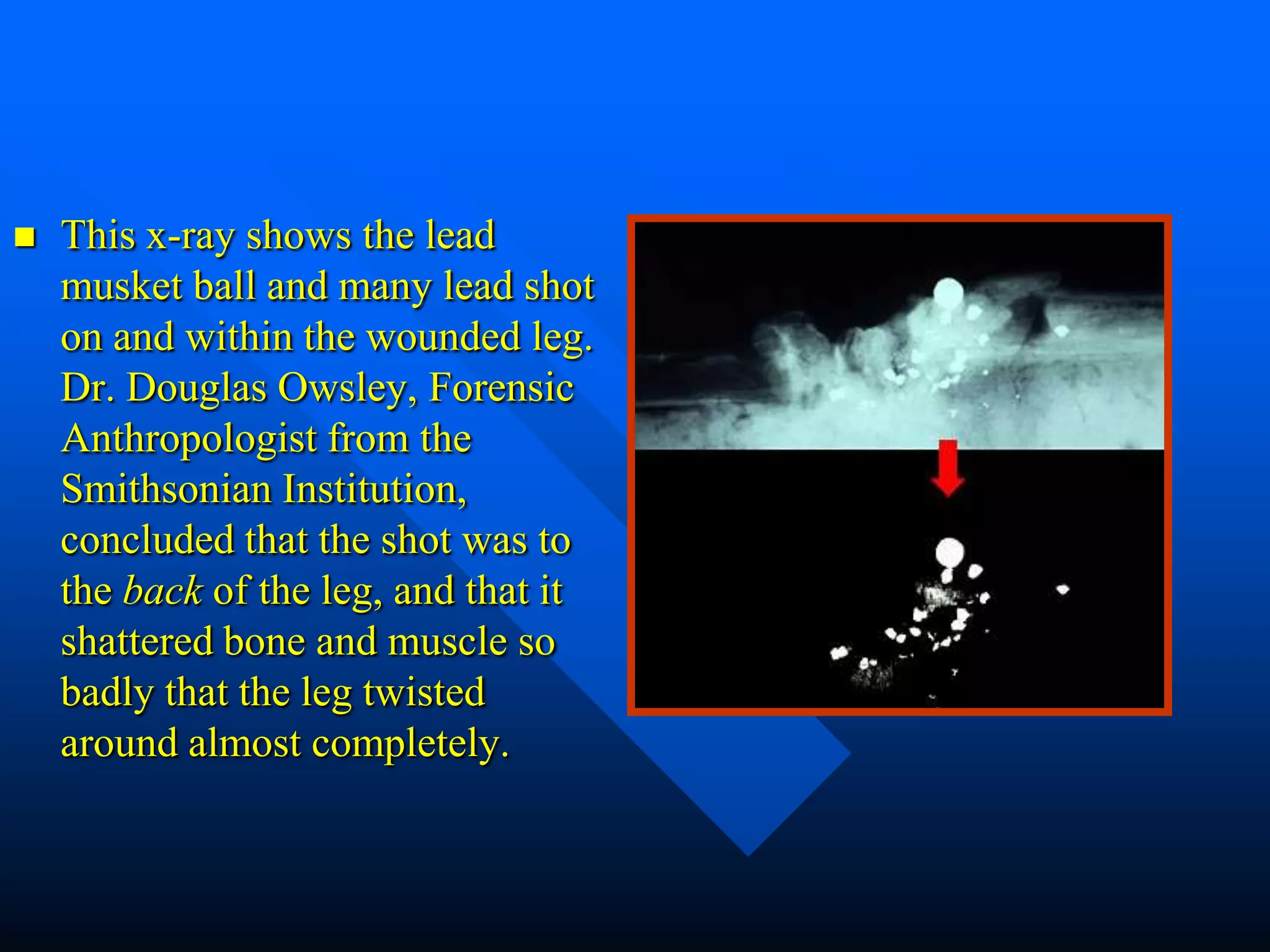    This x-ray shows the lead
    musket ball and many lead shot
    on and within the wounded leg.
    Dr. Douglas Owsley, Forensic
    Anthropologist from the
    Smithsonian Institution,
    concluded that the shot was to
    the back of the leg, and that it
    shattered bone and muscle so
    badly that the leg twisted
    around almost completely.
 