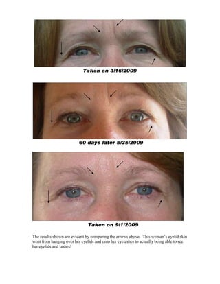 The results shown are evident by comparing the arrows above. This woman’s eyelid skin
went from hanging over her eyelids and onto her eyelashes to actually being able to see
her eyelids and lashes!
 