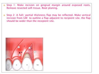  Step 1: Make incision on gingival margin around exposed roots.
Remove resected soft tissue. Root planing.
 Step 2: A full/ partial thickness flap may be reflected. Make vertical
incision from GM to outline a flap adjacent to recipient site. the flap
should be wider than the recepient site.
 