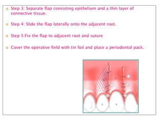  Step 3: Separate flap consisting epithelium and a thin layer of
connective tissue.
 Step 4: Slide the flap laterally onto the adjacent root.
 Step 5:Fix the flap to adjacent root and suture
 Cover the operative field with tin foil and place a periodontal pack.
 