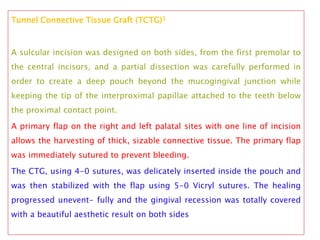 Tunnel Connective Tissue Graft (TCTG)3
A sulcular incision was designed on both sides, from the first premolar to
the central incisors, and a partial dissection was carefully performed in
order to create a deep pouch beyond the mucogingival junction while
keeping the tip of the interproximal papillae attached to the teeth below
the proximal contact point.
A primary flap on the right and left palatal sites with one line of incision
allows the harvesting of thick, sizable connective tissue. The primary flap
was immediately sutured to prevent bleeding.
The CTG, using 4-0 sutures, was delicately inserted inside the pouch and
was then stabilized with the flap using 5-0 Vicryl sutures. The healing
progressed unevent- fully and the gingival recession was totally covered
with a beautiful aesthetic result on both sides
 