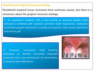 Multifactorial Gingival Recession Etiology
Periodontal marginal tissue recessions have numerous causes, but there is a
consensus about the gingival recession etiology.
1. An anatomical condition with a pre-existing or acquired alveolar bone
dehiscence combined with localized prominent tooth malposition, inadequate
keratinized gingival dimensions in quality and quantity, high muscle attachment
and frenum pull.
2. Traumatic, overzealous tooth brushing
techniques (ie, forceful, horizontal) frequently
associated with a pre-existing lack of cortical bone,
or acquired bone dehiscence.
 
