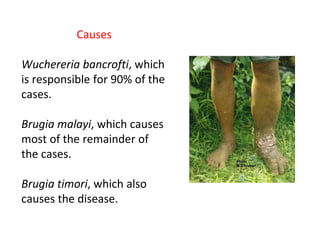 Causes
Wuchereria bancrofti, which
is responsible for 90% of the
cases.
Brugia malayi, which causes
most of the remainder of
the cases.
Brugia timori, which also
causes the disease.
 