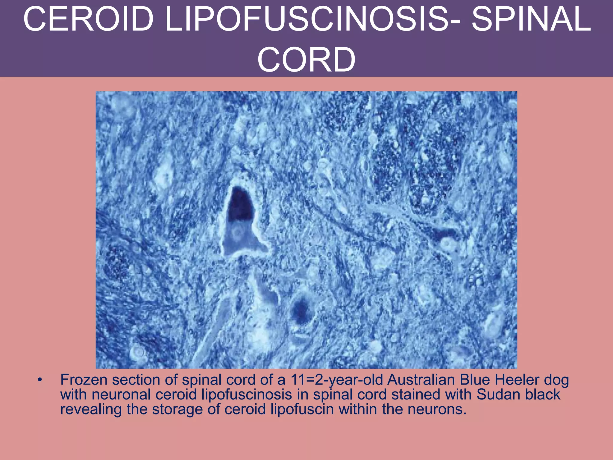 Lysosomal storage diseases PPTX