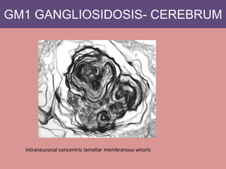GM1 GANGLIOSIDOSIS- CEREBRUM
Intraneuronal concentric lamellar membranous whorls
 