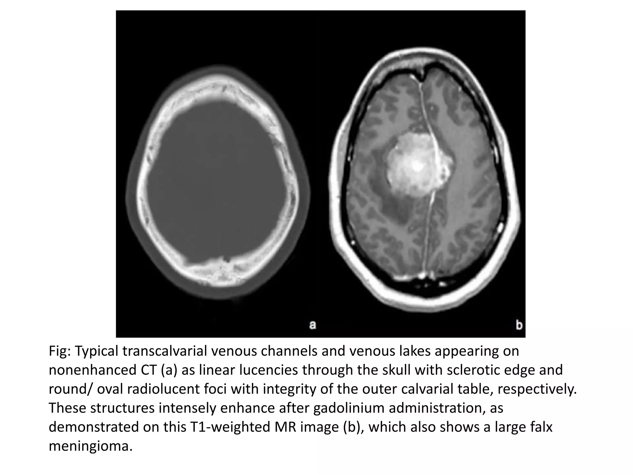 Fig: Typical transcalvarial venous channels and venous lakes appearing on
nonenhanced CT (a) as linear lucencies through the skull with sclerotic edge and
round/ oval radiolucent foci with integrity of the outer calvarial table, respectively.
These structures intensely enhance after gadolinium administration, as
demonstrated on this T1-weighted MR image (b), which also shows a large falx
meningioma.
 