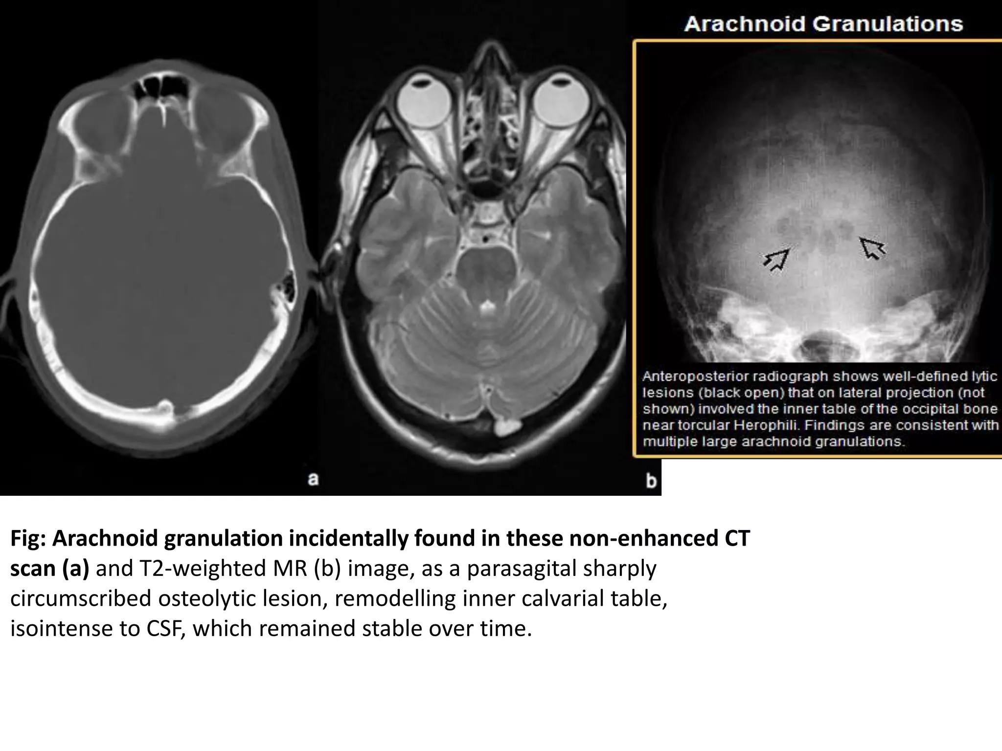 Fig: Arachnoid granulation incidentally found in these non-enhanced CT
scan (a) and T2-weighted MR (b) image, as a parasagital sharply
circumscribed osteolytic lesion, remodelling inner calvarial table,
isointense to CSF, which remained stable over time.
 