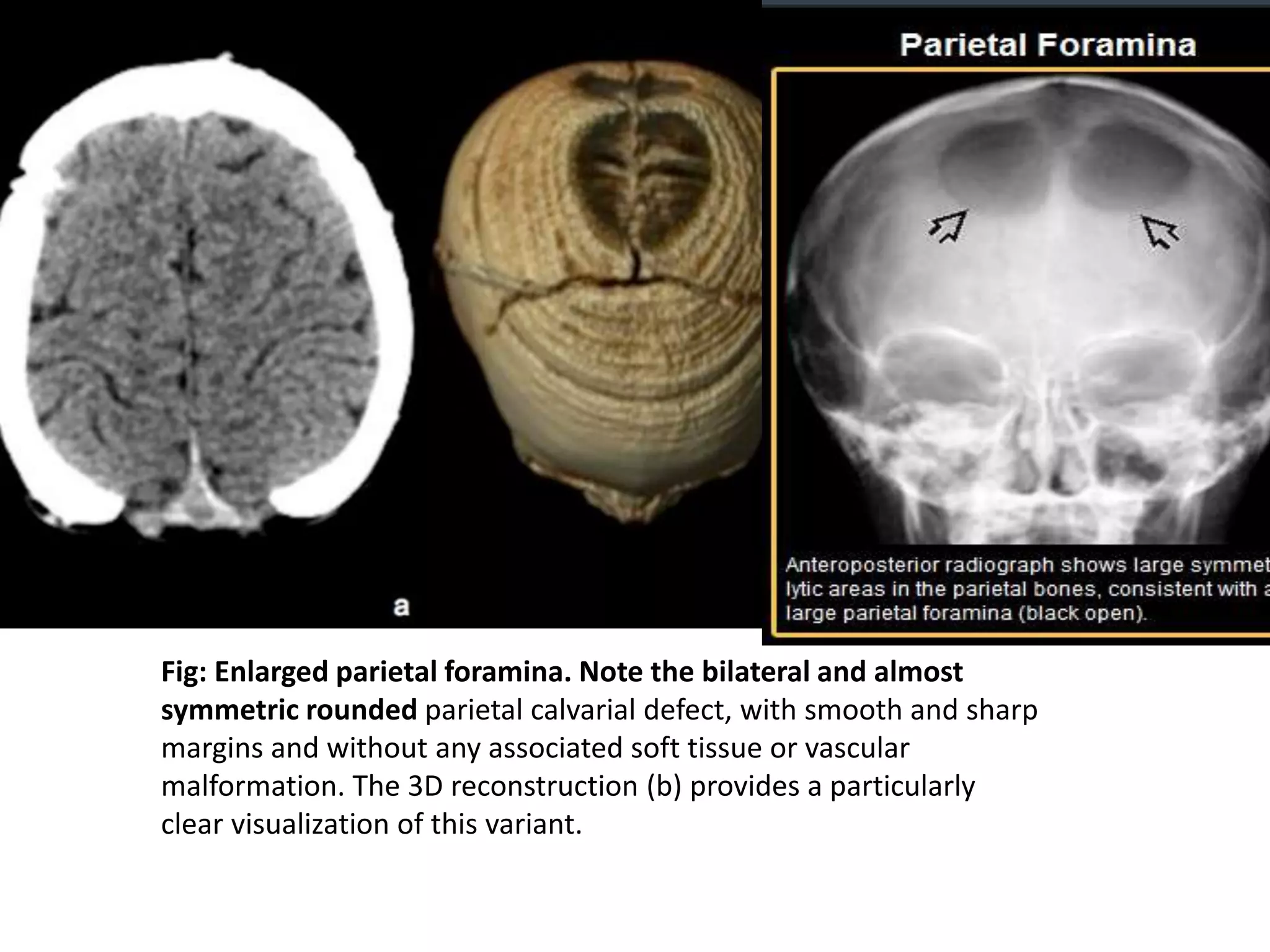 Fig: Enlarged parietal foramina. Note the bilateral and almost
symmetric rounded parietal calvarial defect, with smooth and sharp
margins and without any associated soft tissue or vascular
malformation. The 3D reconstruction (b) provides a particularly
clear visualization of this variant.
 