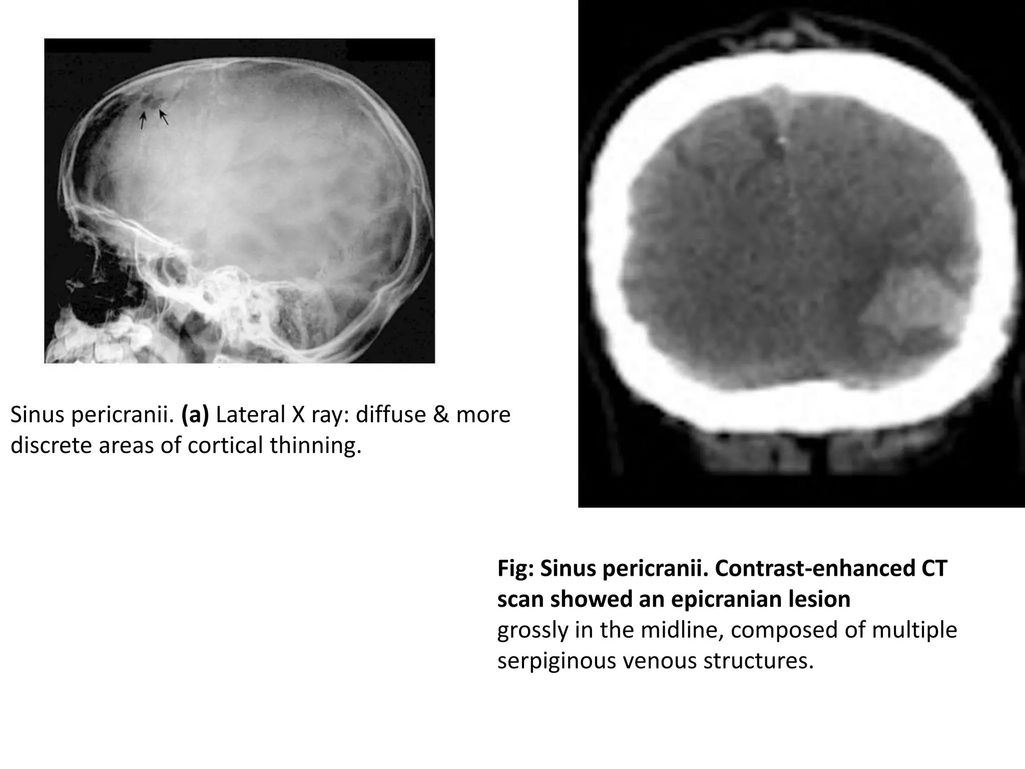 Fig: Sinus pericranii. Contrast-enhanced CT
scan showed an epicranian lesion
grossly in the midline, composed of multiple
serpiginous venous structures.
Sinus pericranii. (a) Lateral X ray: diffuse & more
discrete areas of cortical thinning.
 