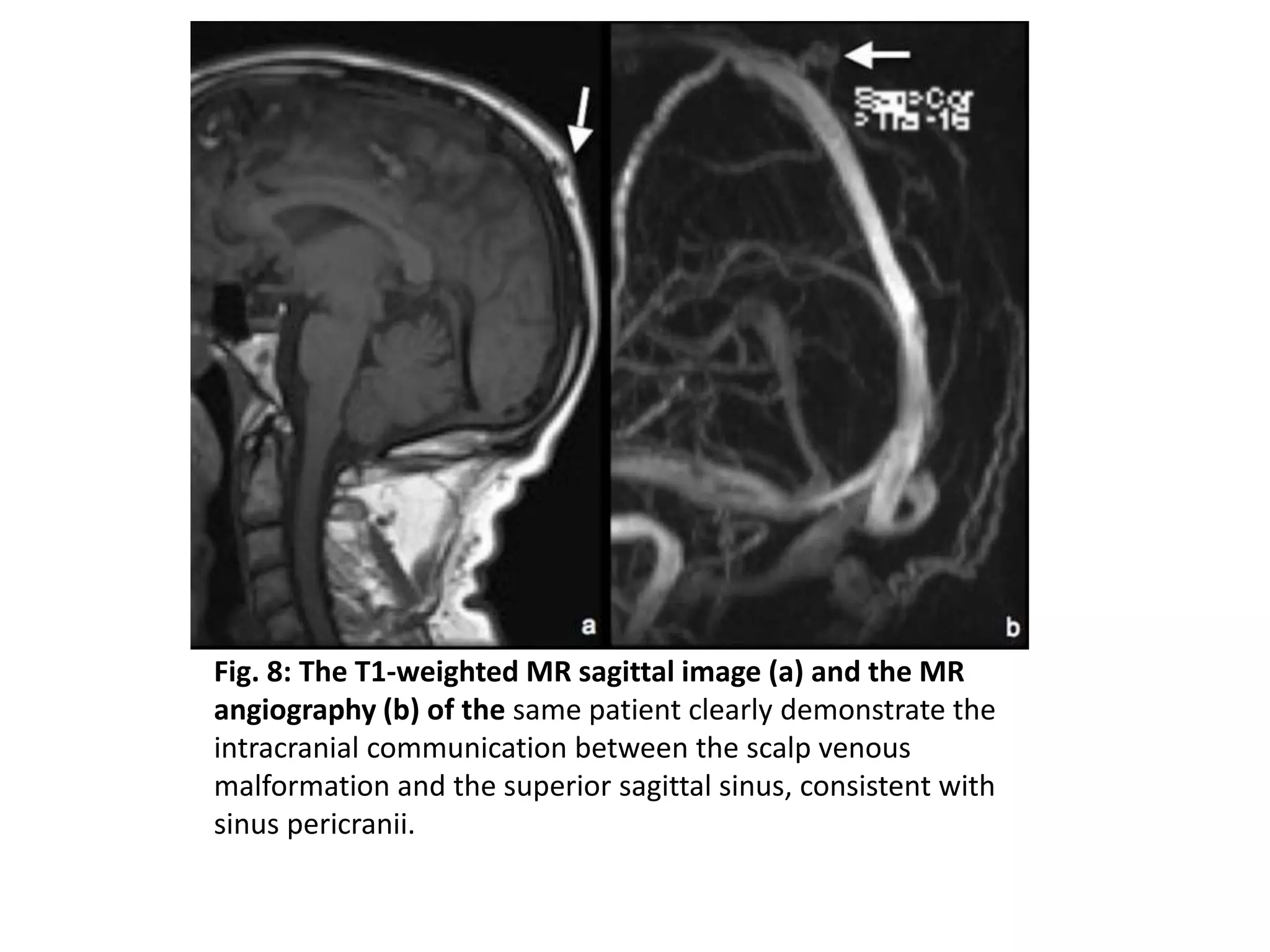 Fig. 8: The T1-weighted MR sagittal image (a) and the MR
angiography (b) of the same patient clearly demonstrate the
intracranial communication between the scalp venous
malformation and the superior sagittal sinus, consistent with
sinus pericranii.
 