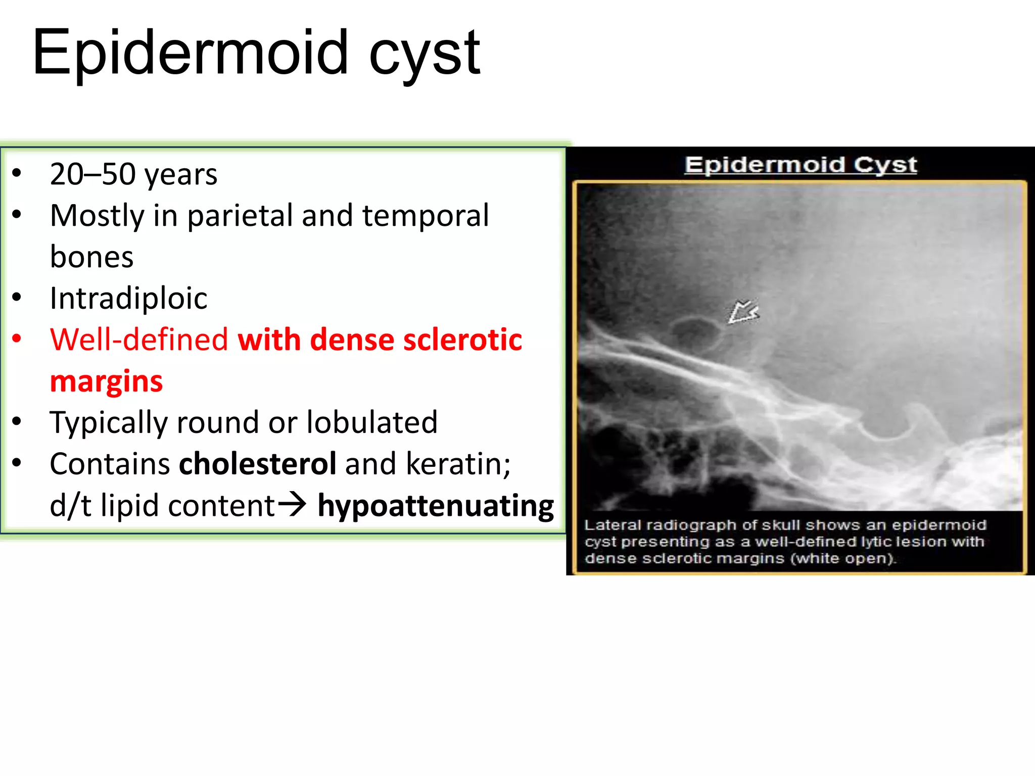 Epidermoid cyst
• 20–50 years
• Mostly in parietal and temporal
bones
• Intradiploic
• Well-defined with dense sclerotic
margins
• Typically round or lobulated
• Contains cholesterol and keratin;
d/t lipid content hypoattenuating
 