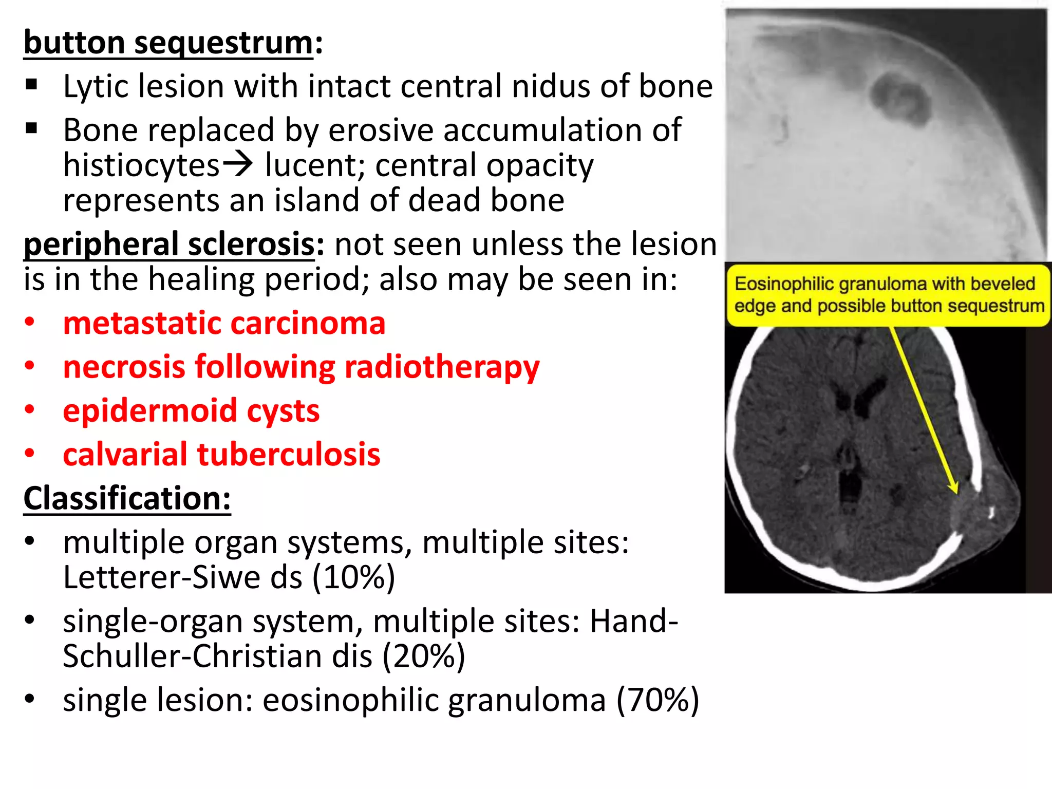 button sequestrum:
 Lytic lesion with intact central nidus of bone
 Bone replaced by erosive accumulation of
histiocytes lucent; central opacity
represents an island of dead bone
peripheral sclerosis: not seen unless the lesion
is in the healing period; also may be seen in:
• metastatic carcinoma
• necrosis following radiotherapy
• epidermoid cysts
• calvarial tuberculosis
Classification:
• multiple organ systems, multiple sites:
Letterer-Siwe ds (10%)
• single-organ system, multiple sites: Hand-
Schuller-Christian dis (20%)
• single lesion: eosinophilic granuloma (70%)
 