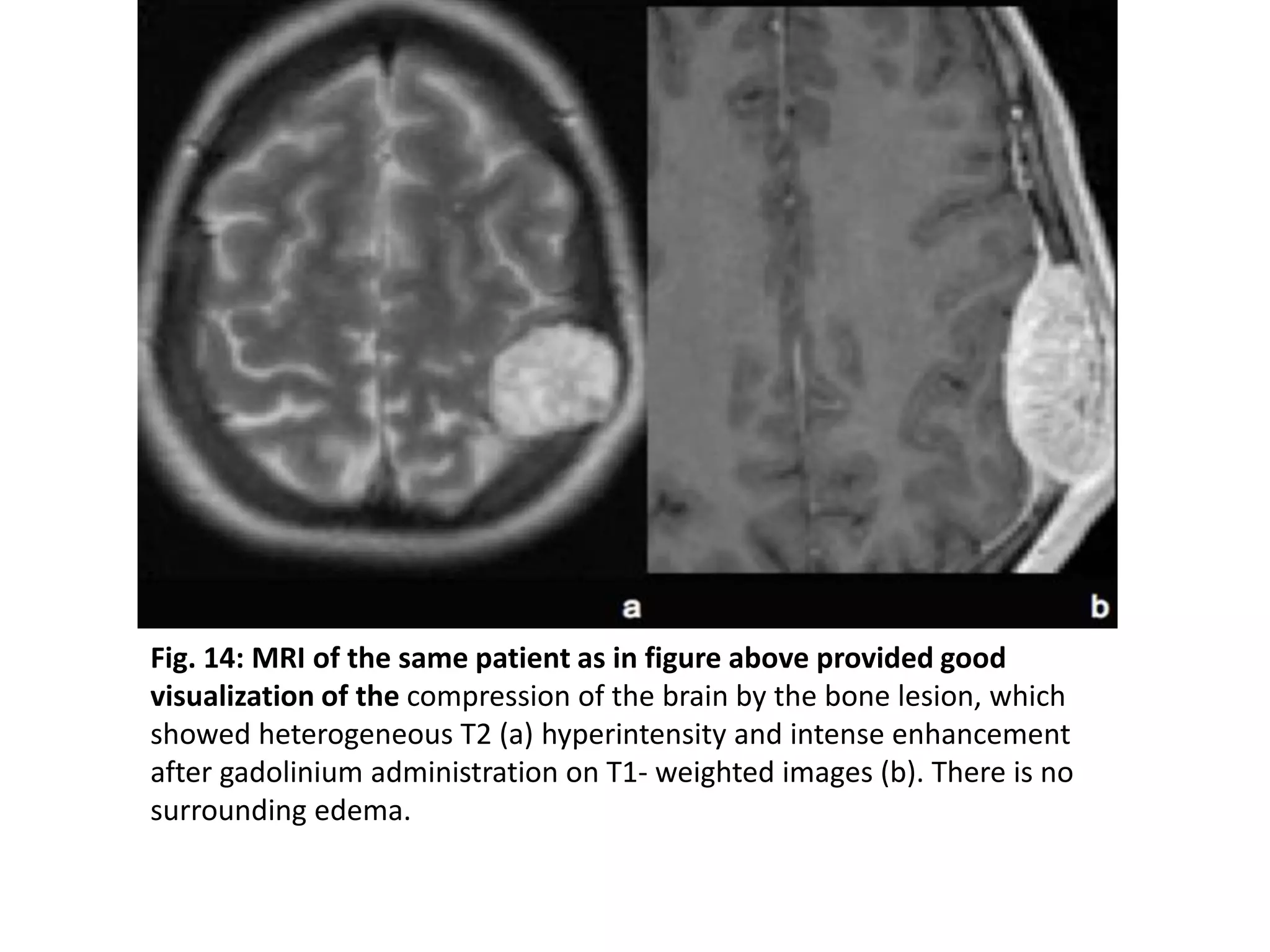 Fig. 14: MRI of the same patient as in figure above provided good
visualization of the compression of the brain by the bone lesion, which
showed heterogeneous T2 (a) hyperintensity and intense enhancement
after gadolinium administration on T1- weighted images (b). There is no
surrounding edema.
 