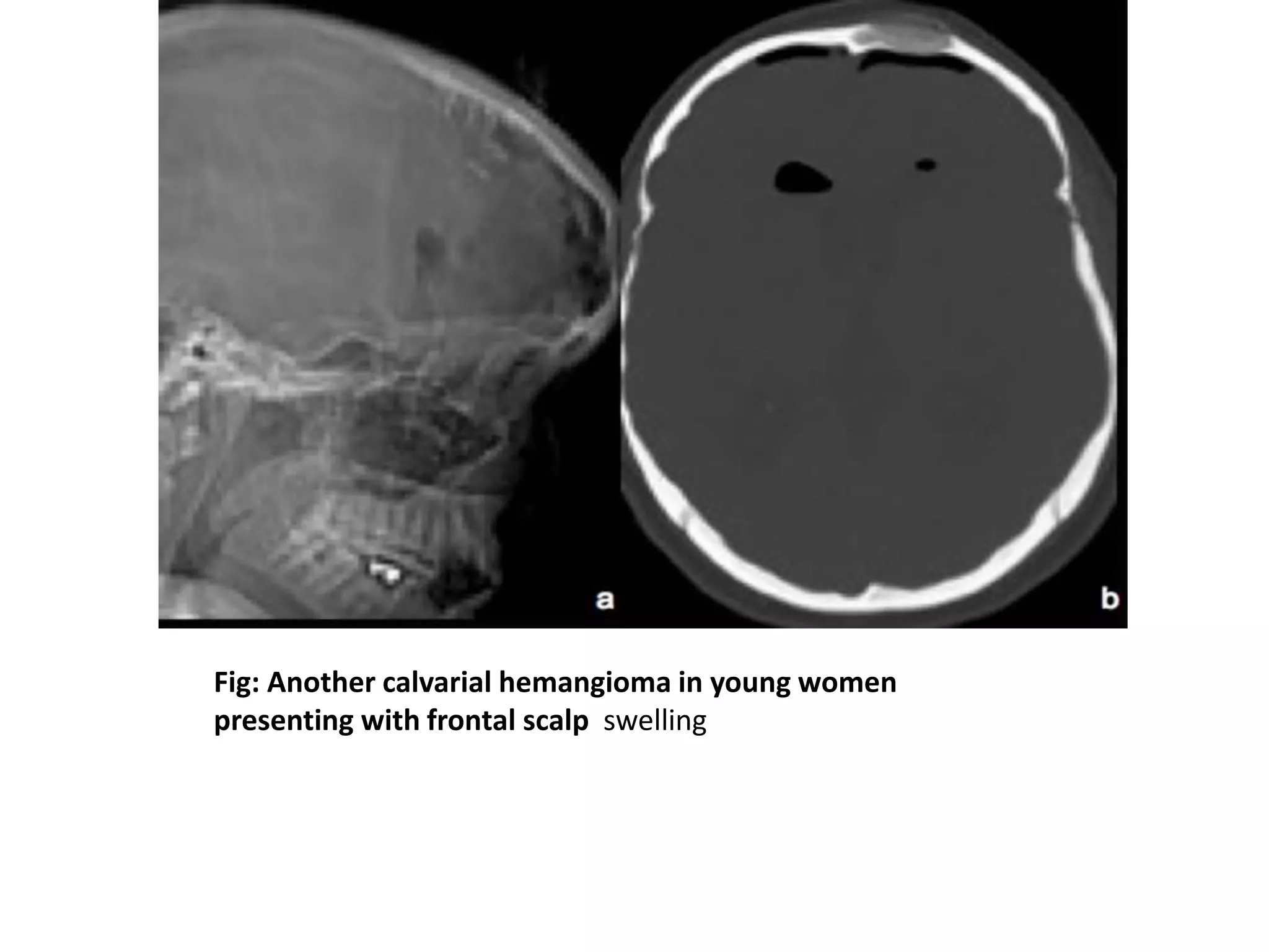 Fig: Another calvarial hemangioma in young women
presenting with frontal scalp swelling
 