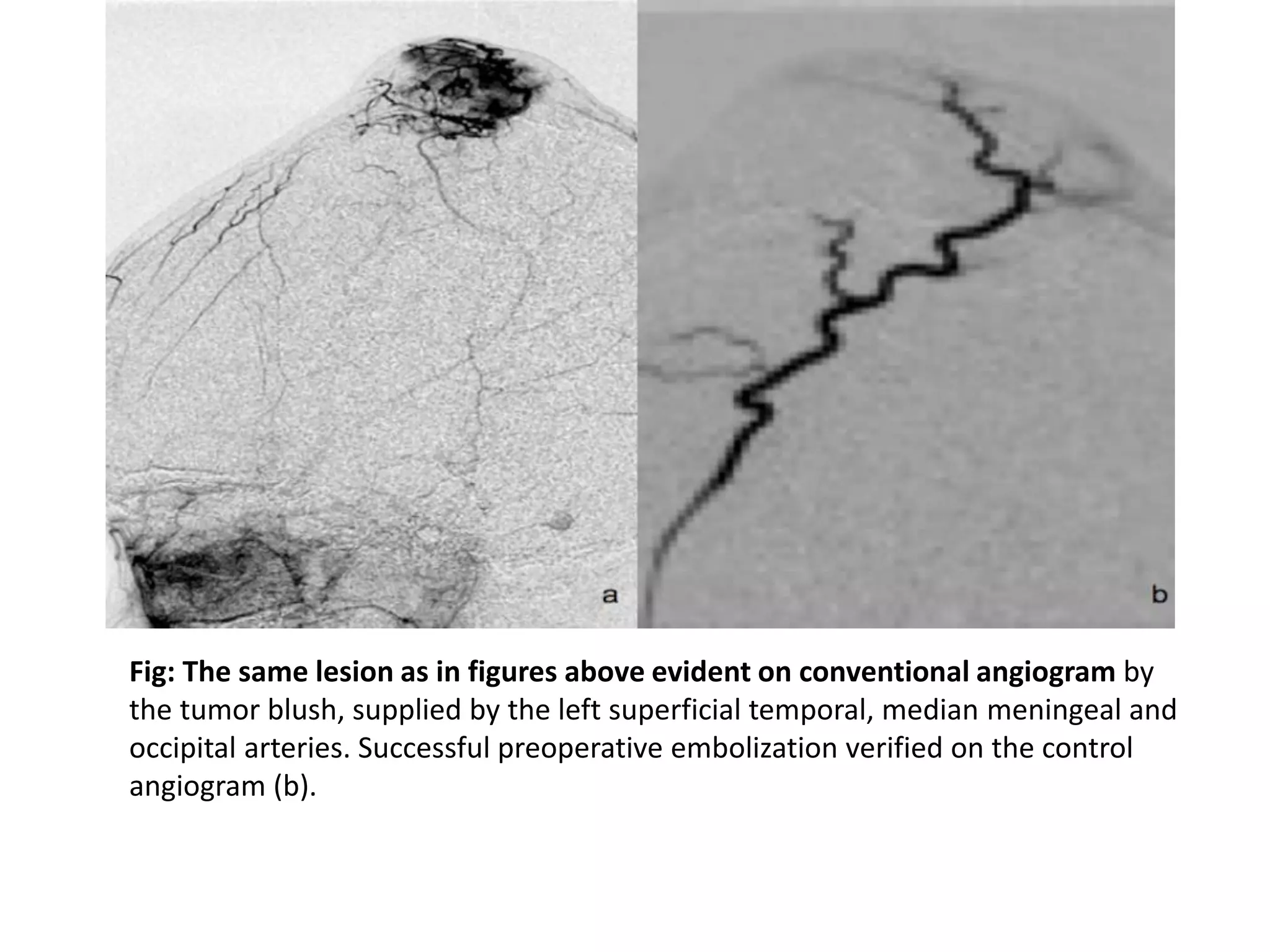 Fig: The same lesion as in figures above evident on conventional angiogram by
the tumor blush, supplied by the left superficial temporal, median meningeal and
occipital arteries. Successful preoperative embolization verified on the control
angiogram (b).
 