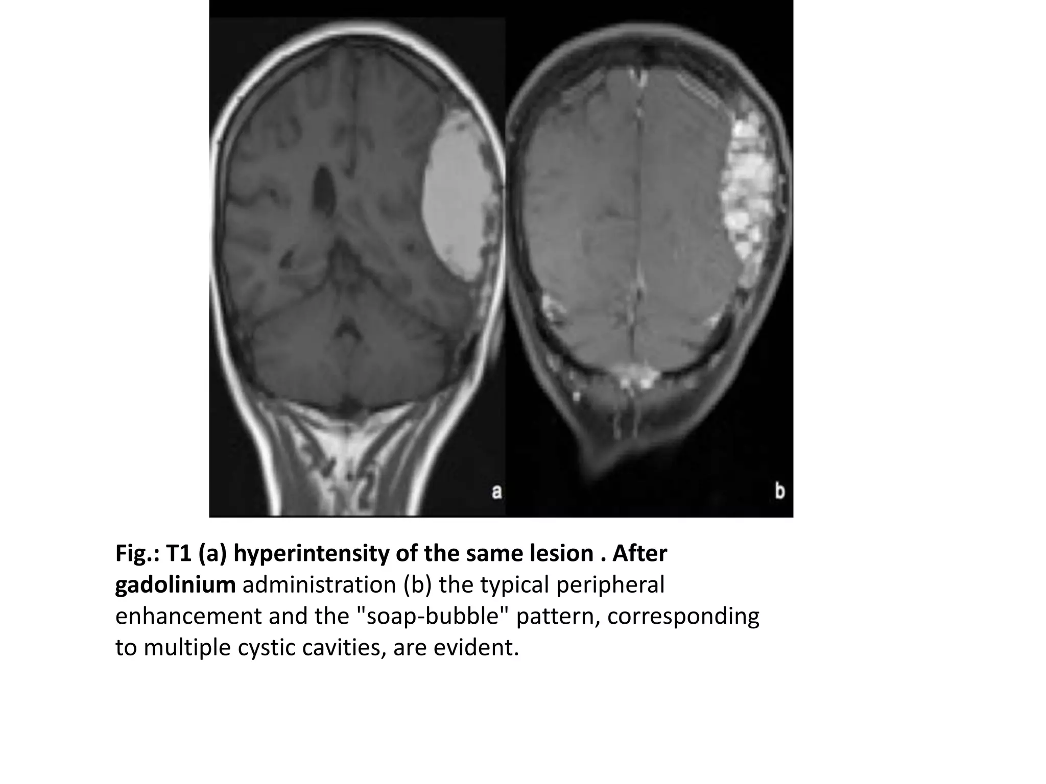Fig.: T1 (a) hyperintensity of the same lesion . After
gadolinium administration (b) the typical peripheral
enhancement and the "soap-bubble" pattern, corresponding
to multiple cystic cavities, are evident.
 