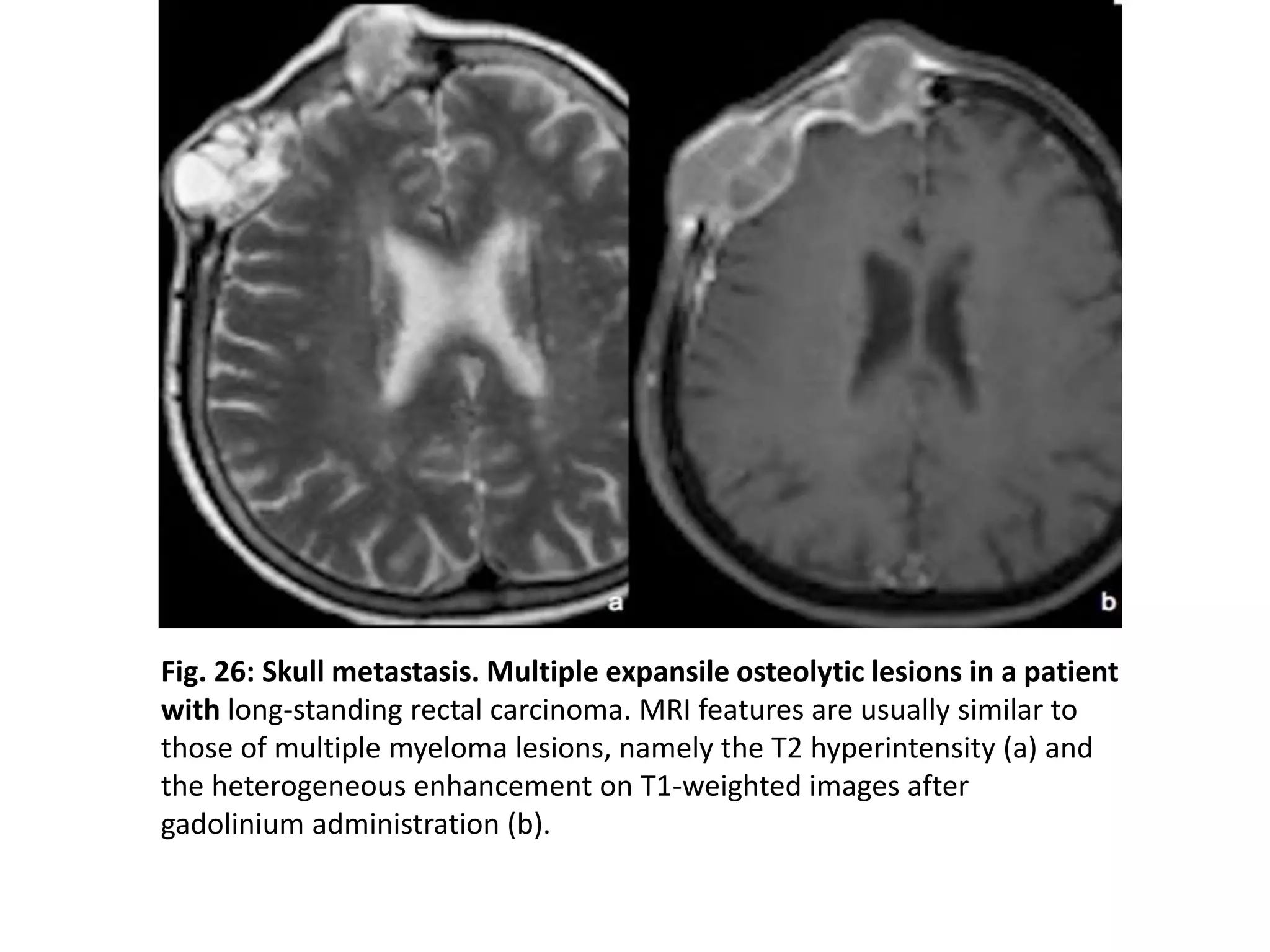 Fig. 26: Skull metastasis. Multiple expansile osteolytic lesions in a patient
with long-standing rectal carcinoma. MRI features are usually similar to
those of multiple myeloma lesions, namely the T2 hyperintensity (a) and
the heterogeneous enhancement on T1-weighted images after
gadolinium administration (b).
 