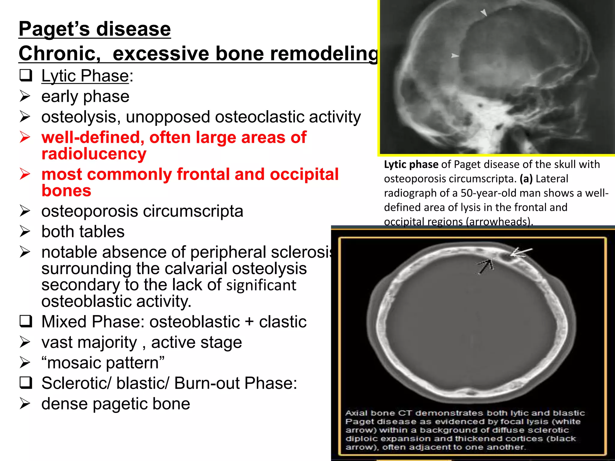 Paget’s disease
Chronic, excessive bone remodeling
 Lytic Phase:
 early phase
 osteolysis, unopposed osteoclastic activity
 well-defined, often large areas of
radiolucency
 most commonly frontal and occipital
bones
 osteoporosis circumscripta
 both tables
 notable absence of peripheral sclerosis
surrounding the calvarial osteolysis
secondary to the lack of significant
osteoblastic activity.
 Mixed Phase: osteoblastic + clastic
 vast majority , active stage
 “mosaic pattern”
 Sclerotic/ blastic/ Burn-out Phase:
 dense pagetic bone
Lytic phase of Paget disease of the skull with
osteoporosis circumscripta. (a) Lateral
radiograph of a 50-year-old man shows a well-
defined area of lysis in the frontal and
occipital regions (arrowheads).
 