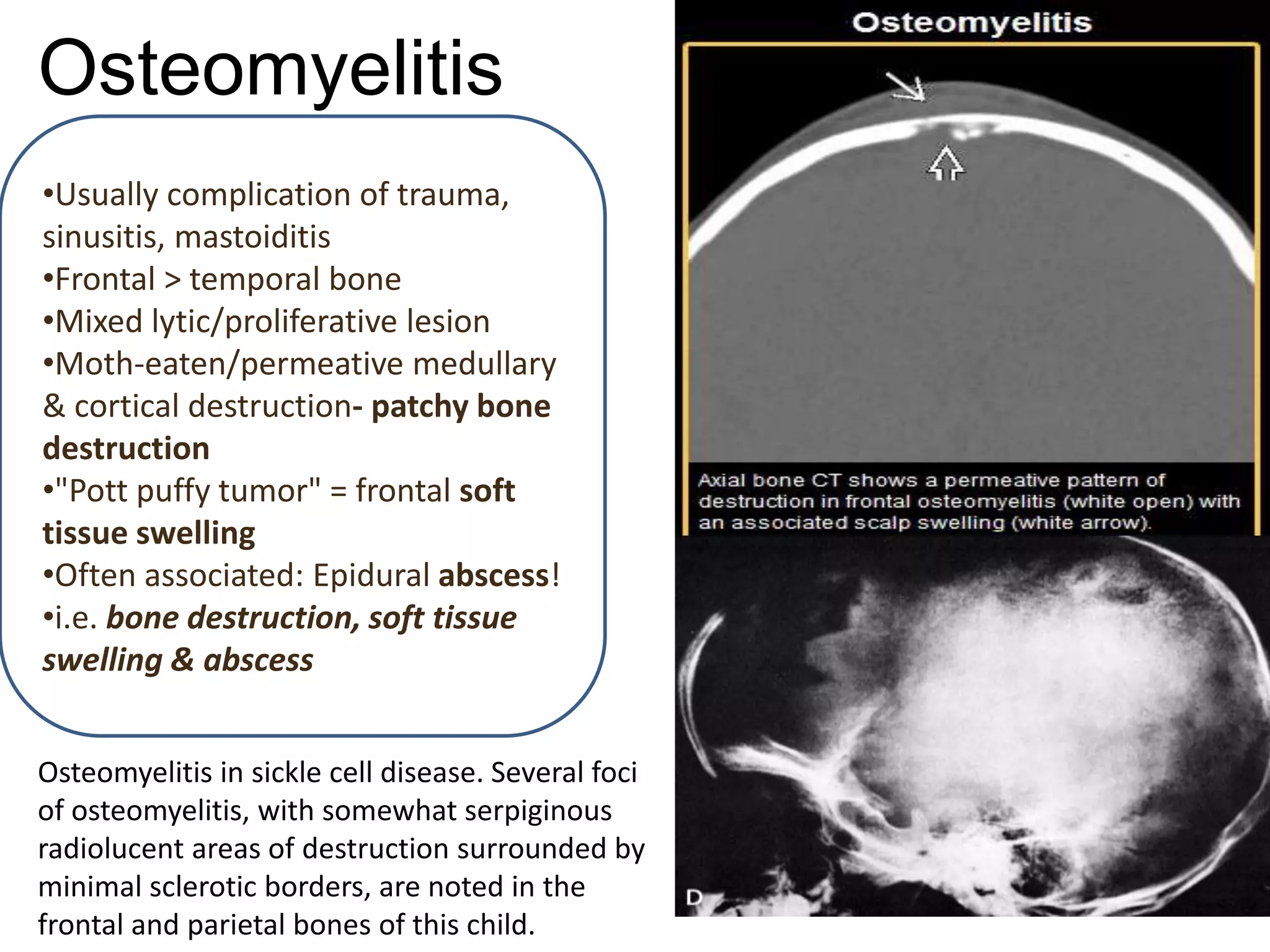 Osteomyelitis
•Usually complication of trauma,
sinusitis, mastoiditis
•Frontal > temporal bone
•Mixed lytic/proliferative lesion
•Moth-eaten/permeative medullary
& cortical destruction- patchy bone
destruction
•"Pott puffy tumor" = frontal soft
tissue swelling
•Often associated: Epidural abscess!
•i.e. bone destruction, soft tissue
swelling & abscess
Osteomyelitis in sickle cell disease. Several foci
of osteomyelitis, with somewhat serpiginous
radiolucent areas of destruction surrounded by
minimal sclerotic borders, are noted in the
frontal and parietal bones of this child.
 