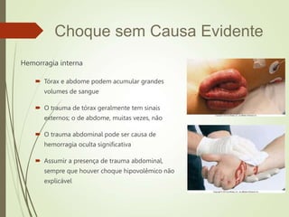 Hemorragia interna
 Tórax e abdome podem acumular grandes
volumes de sangue
 O trauma de tórax geralmente tem sinais
externos; o de abdome, muitas vezes, não
 O trauma abdominal pode ser causa de
hemorragia oculta significativa
 Assumir a presença de trauma abdominal,
sempre que houver choque hipovolêmico não
explicável
Choque sem Causa Evidente
 