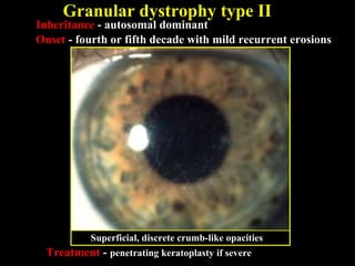 Inheritance - autosomal dominant
Onset - fourth or fifth decade with mild recurrent erosions
Superficial, discrete crumb-like opacities
Treatment - penetrating keratoplasty if severe
Granular dystrophy type II
 