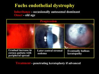Inheritance - occasionally autosomal dominant
Onset - old age
Treatment - penetrating keratoplasty if advanced
Fuchs endothelial dystrophy
Eventually bullous
keratopathy
Later central stromal
oedema
Gradual increase in
cornea guttata with
peripheral spread
Progression
 