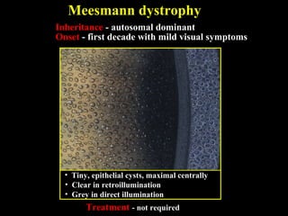 Meesmann dystrophy
Inheritance - autosomal dominant
Onset - first decade with mild visual symptoms
Treatment - not required
• Clear in retroillumination
• Grey in direct illumination
• Tiny, epithelial cysts, maximal centrally
 