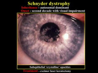 Inheritance - autosomal dominant
Onset - second decade with visual impairment
Treatment - excimer laser keratectomy
Schnyder dystrophy
Subepithelial ‘crystalline’ opacities
 