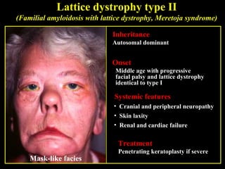 Inheritance
Autosomal dominant
Onset
Middle age with progressive
facial palsy and lattice dystrophy
identical to type I
Systemic features
• Cranial and peripheral neuropathy
• Skin laxity
• Renal and cardiac failure
Treatment
Penetrating keratoplasty if severe
Lattice dystrophy type II
(Familial amyloidosis with lattice dystrophy, Meretoja syndrome)
Mask-like facies
 