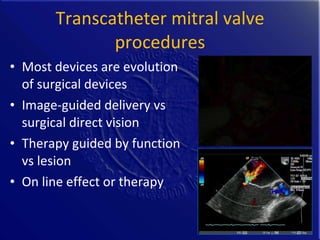 History and Future of Transcatheter Mitral Valve Interventions | PPT