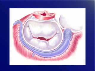 History and Future of Transcatheter Mitral Valve Interventions | PPT
