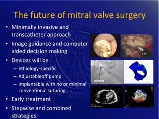 History and Future of Transcatheter Mitral Valve Interventions | PPT