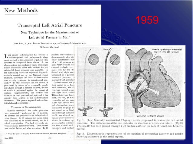 History and Future of Transcatheter Mitral Valve Interventions | PPT