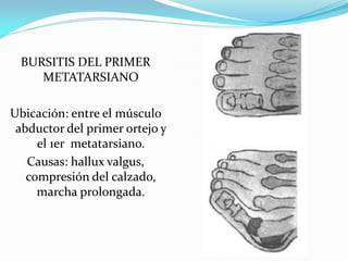 BURSITIS DEL PRIMER
METATARSIANO
Ubicación: entre el músculo
abductor del primer ortejo y
el 1er metatarsiano.
Causas: hallux valgus,
compresión del calzado,
marcha prolongada.
 